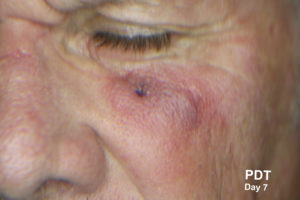 BCC treated with PDT at queendland skin cancer clinic