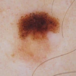 melanoma