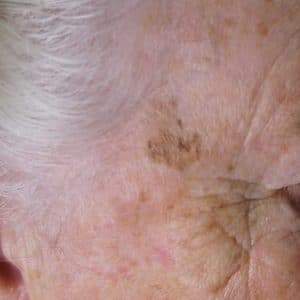 Melanoma on face