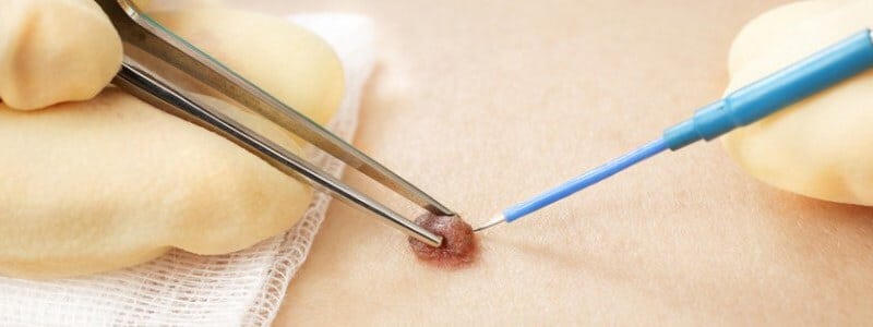 RF radiofrequency cosmetic mole removal