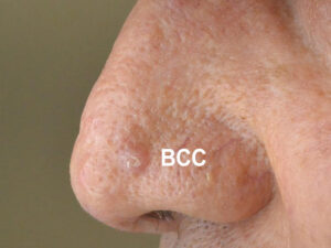 BCC