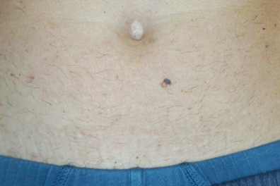 Melanoma