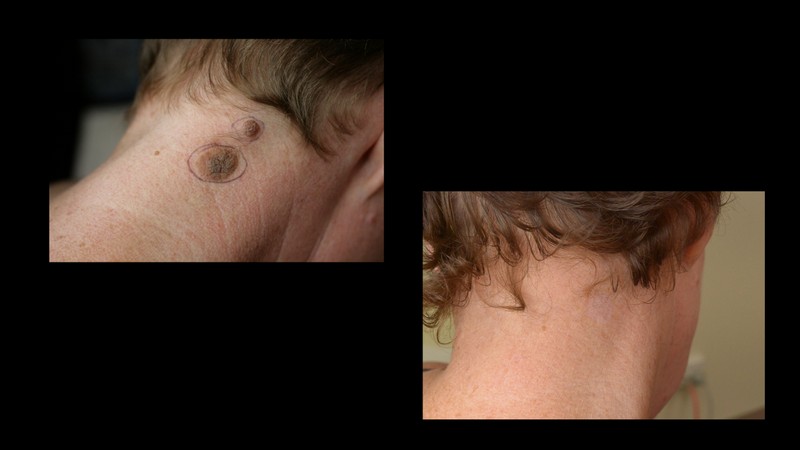 Radiofrequency mole removal