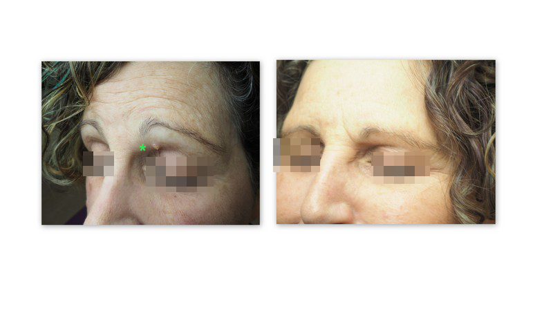 Radiofrequency mole removal