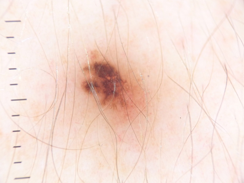 Melanoma