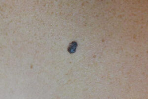 melanoma