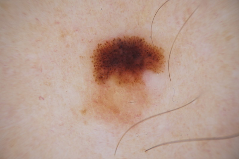 melanoma