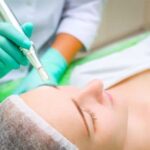 microneedling