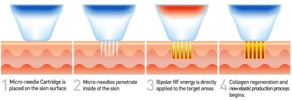 RF