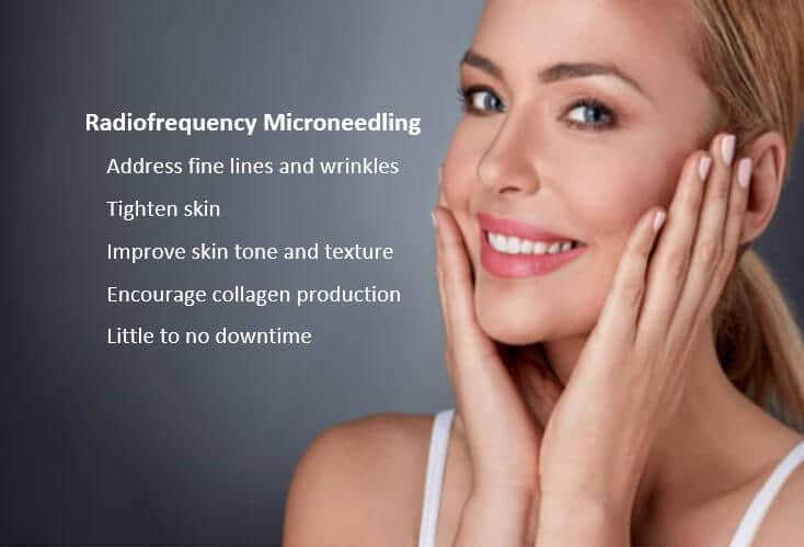 RF microoneedling