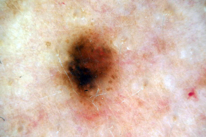 dysplastic mole