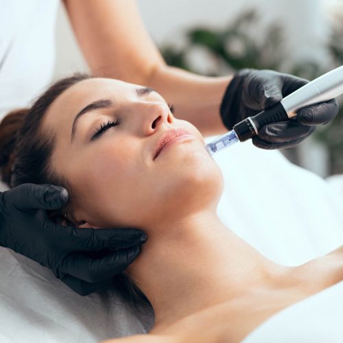 microneedling